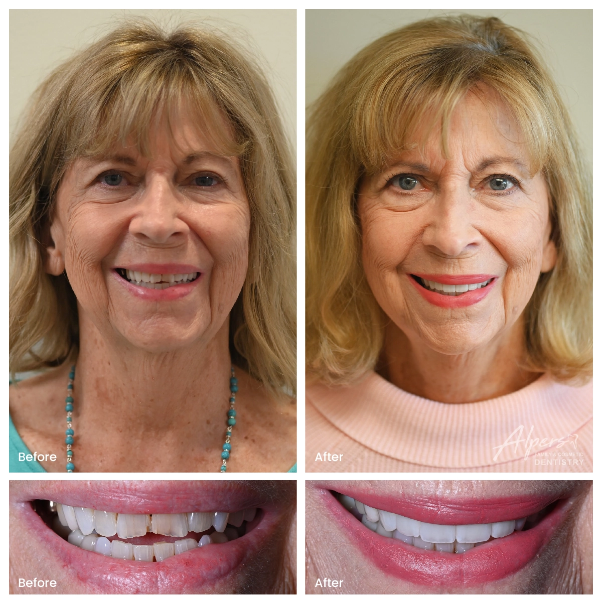 Before and after photos of a patient with four natural-looking veneers showing a subtle cosmetic smile transformation without fake-looking results.