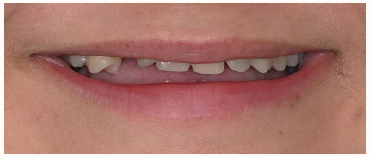 Before smile showing a large gap from multiple missing upper front teeth and uneven spacing
