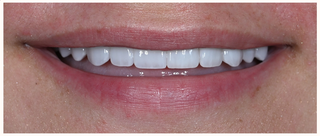 After smile showing a complete, natural-looking upper smile with balanced, symmetrical front teeth