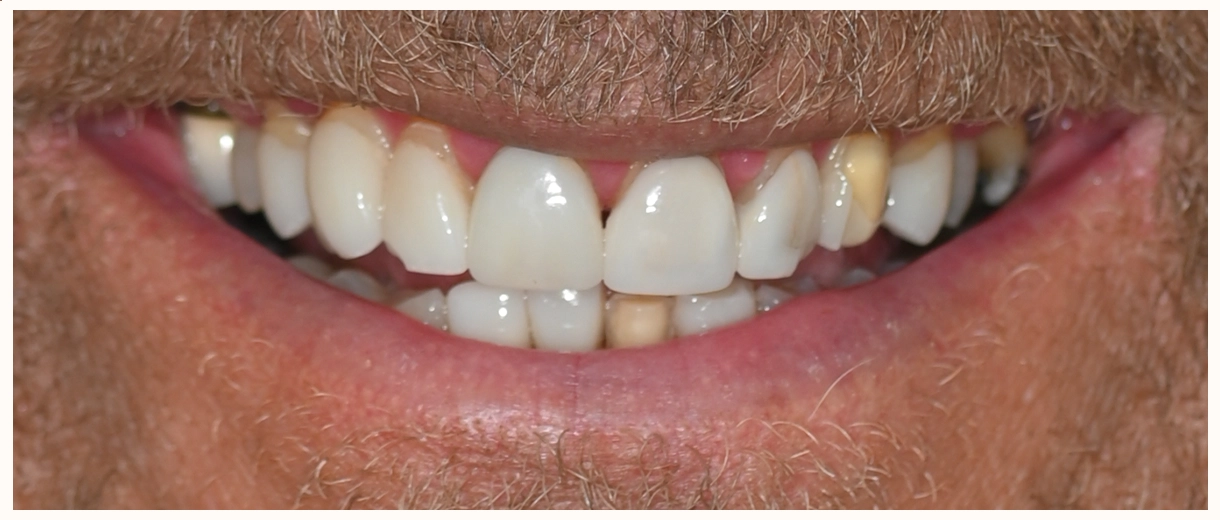Before smile showing broken and worn veneers, uneven teeth, and signs of a collapsed bite