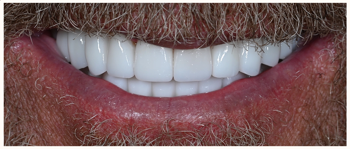 After smile showing a strong, healthy-looking smile with natural tooth proportions and improved bite alignment