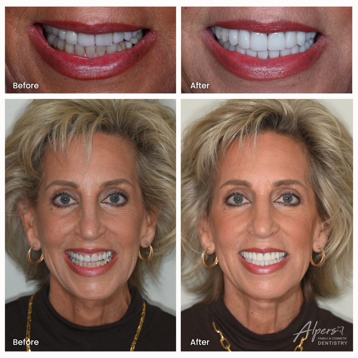 Before-and-after photos of a full mouth rehabilitation with crowns, bridges, dental implants, porcelain veneers, and gum symmetry correction.