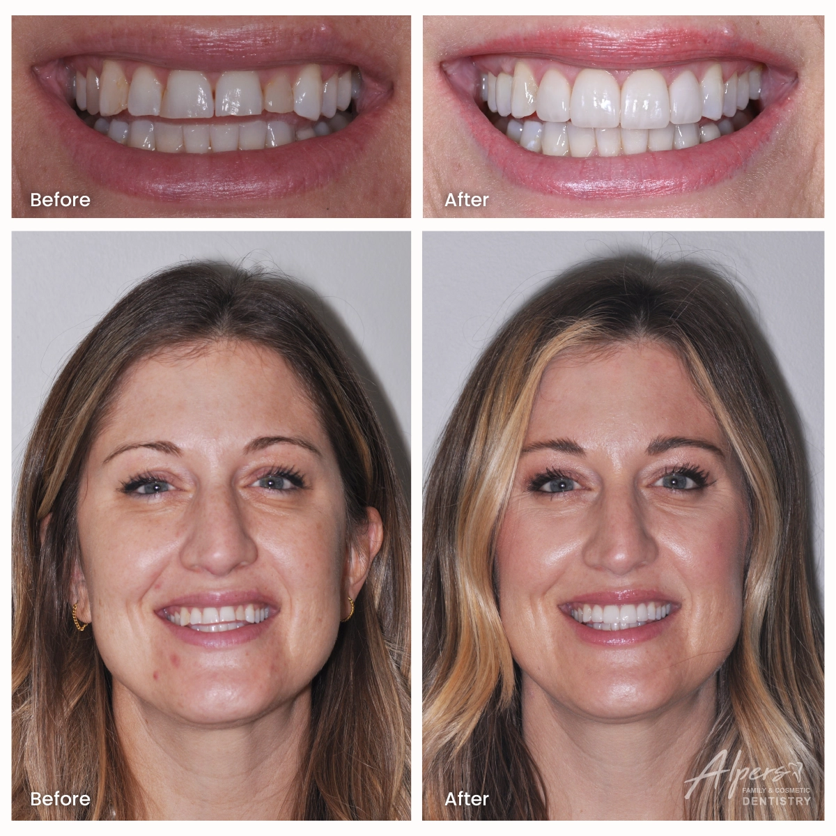 Before-and-after photos showing gummy smile correction on two teeth combined with four porcelain veneers and a back-tooth dental implant.