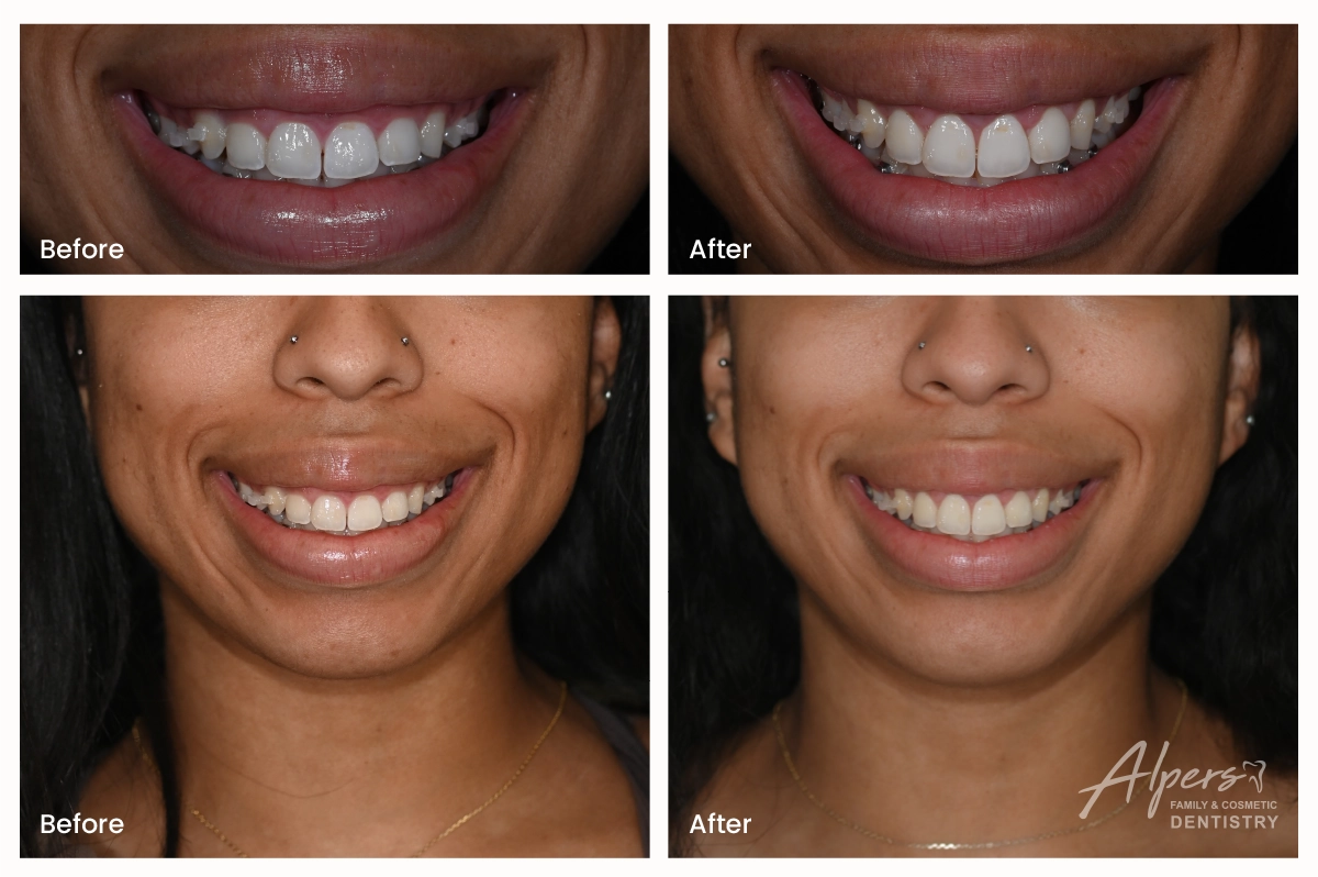 Before-and-after photos of gummy smile correction showing longer-looking teeth and less visible gum tissue after gum contouring.