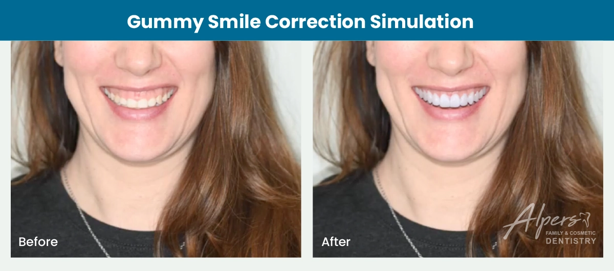 Side-by-side gummy smile correction simulation showing more visible tooth structure and less gum tissue after treatment.