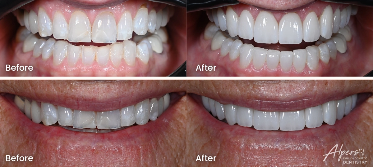 Before and after of Rachel’s smile and retracted teeth following Invisalign and porcelain veneers and crowns to restore severely worn teeth.