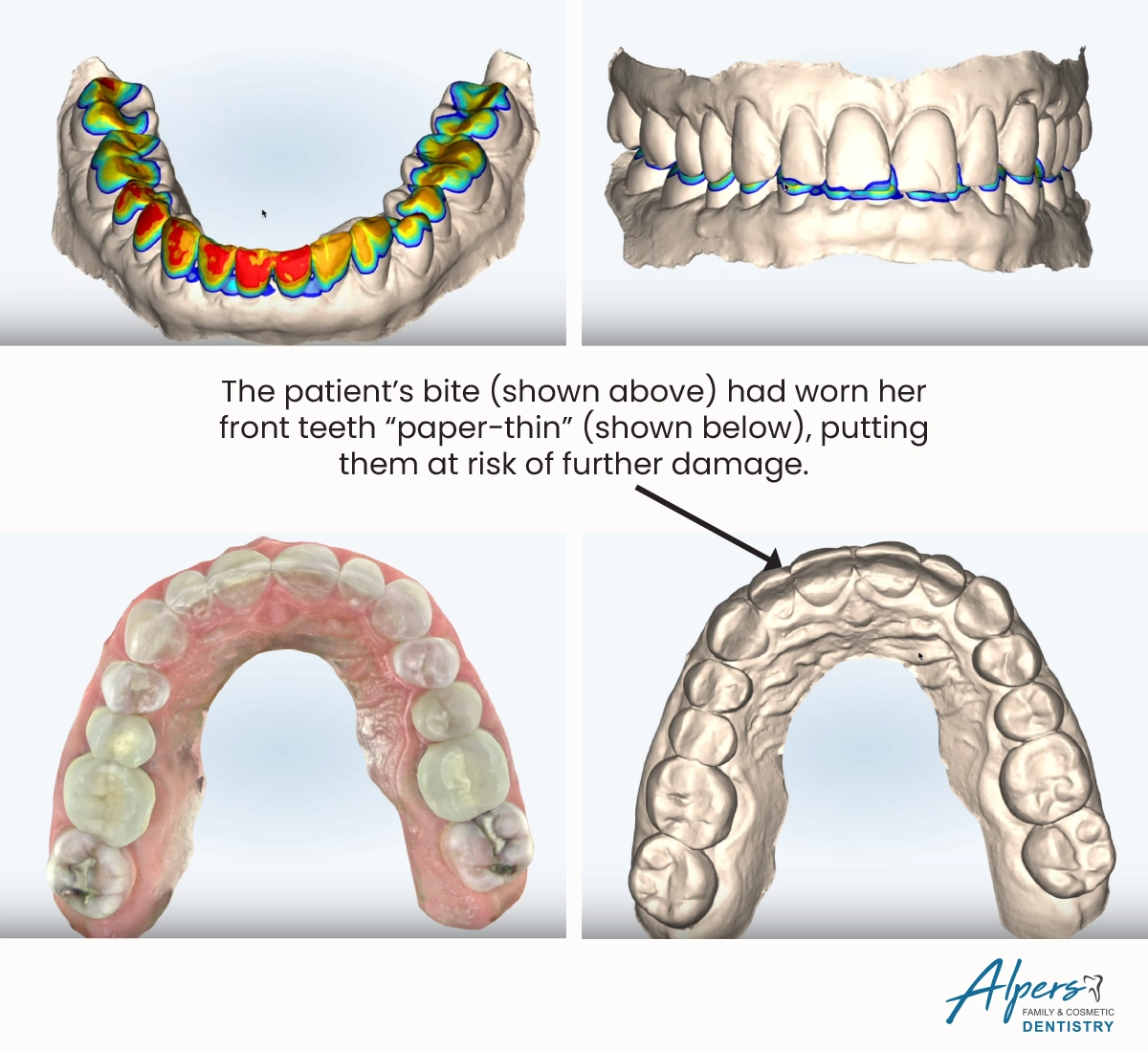 Digital dental scans showing heavy bite contact on Rachel’s front teeth and severe wear that left her upper front teeth extremely thin.