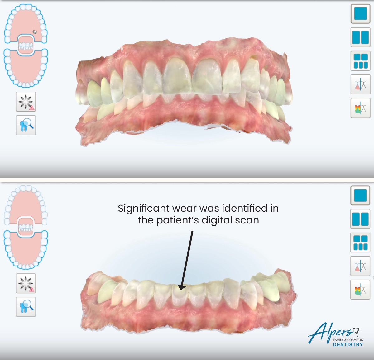 Digital dental scans showing Rachel’s severely worn upper and lower front teeth before Invisalign treatment.