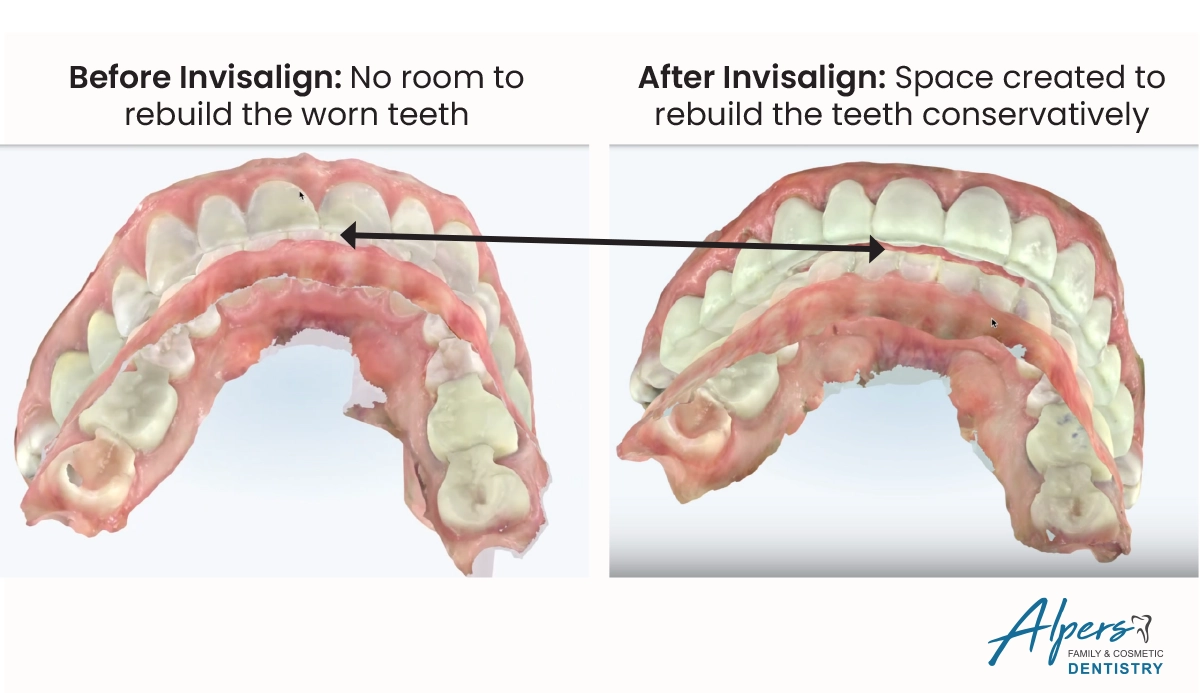Before-and-after digital dental scans showing space created between Rachel’s front teeth with Invisalign before veneers and restorative treatment.