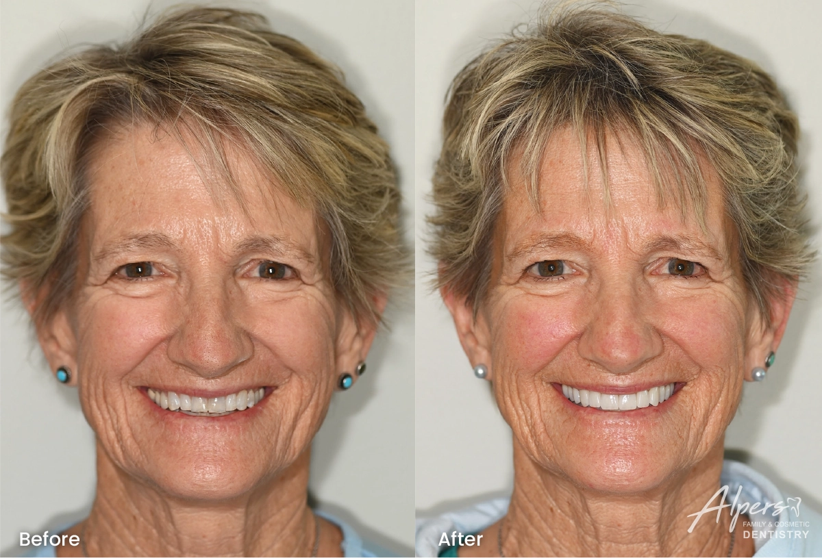 Before-and-after portrait of Rachel’s smile transformation with Invisalign, porcelain veneers and crowns for severely worn teeth.