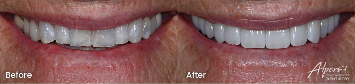 Before-and-after close-up of Rachel’s smile showing 12 restored upper teeth and a seamless transition across her wide smile.