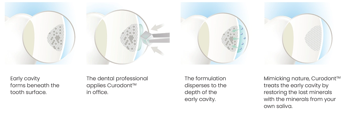 Illustration showing how Curodont is applied to an early cavity and penetrates beneath the tooth surface to support remineralization using minerals from saliva.