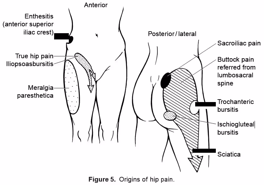 RheumaKnowledgy » Hip Pain