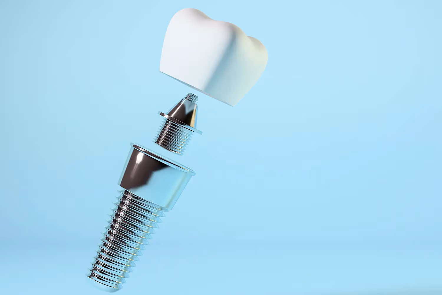 How Long is The Dental Implant Recovery Process?