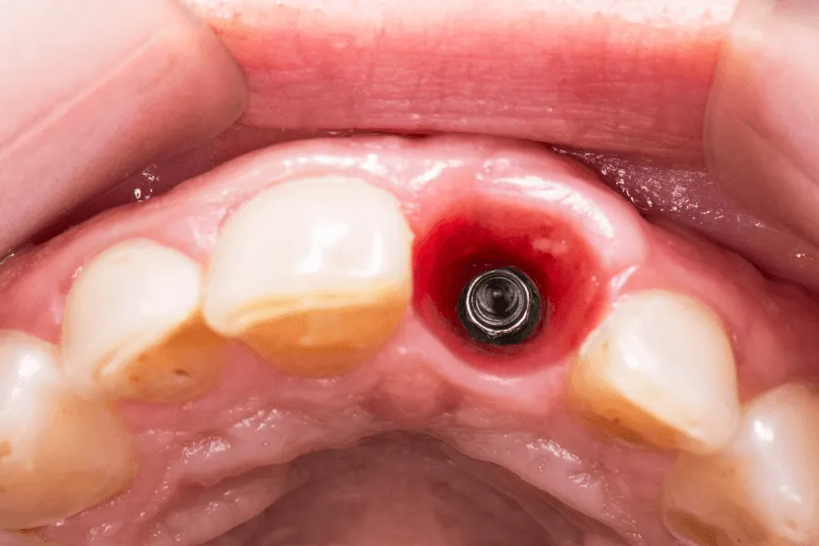 koszt-pojedynczego-implantu-zeba-szczecin-wycena-zabiegu