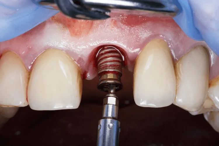 bezpieczny-trening-po-zabiegu-implantacji