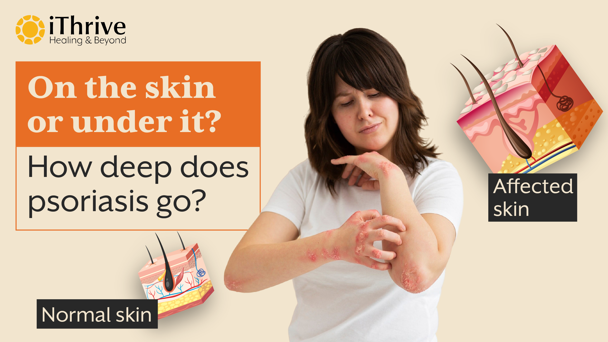 Psoriasis | How Deep is it Rooted?