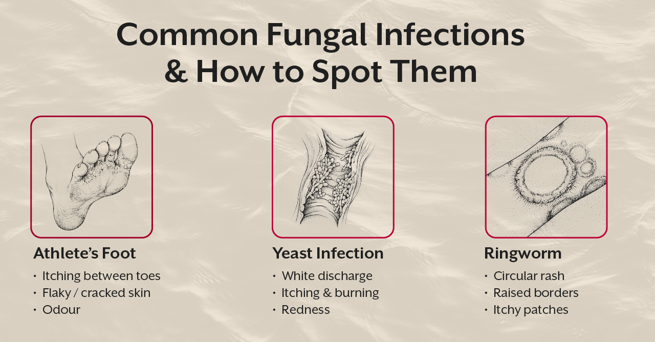 Common Fungal Infections & How to Spot Them