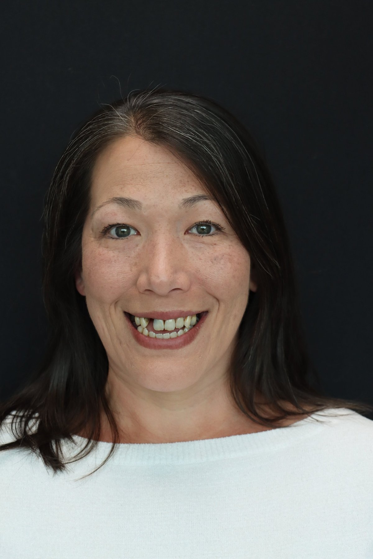 Lynnwood dental implants before and after patient transformation