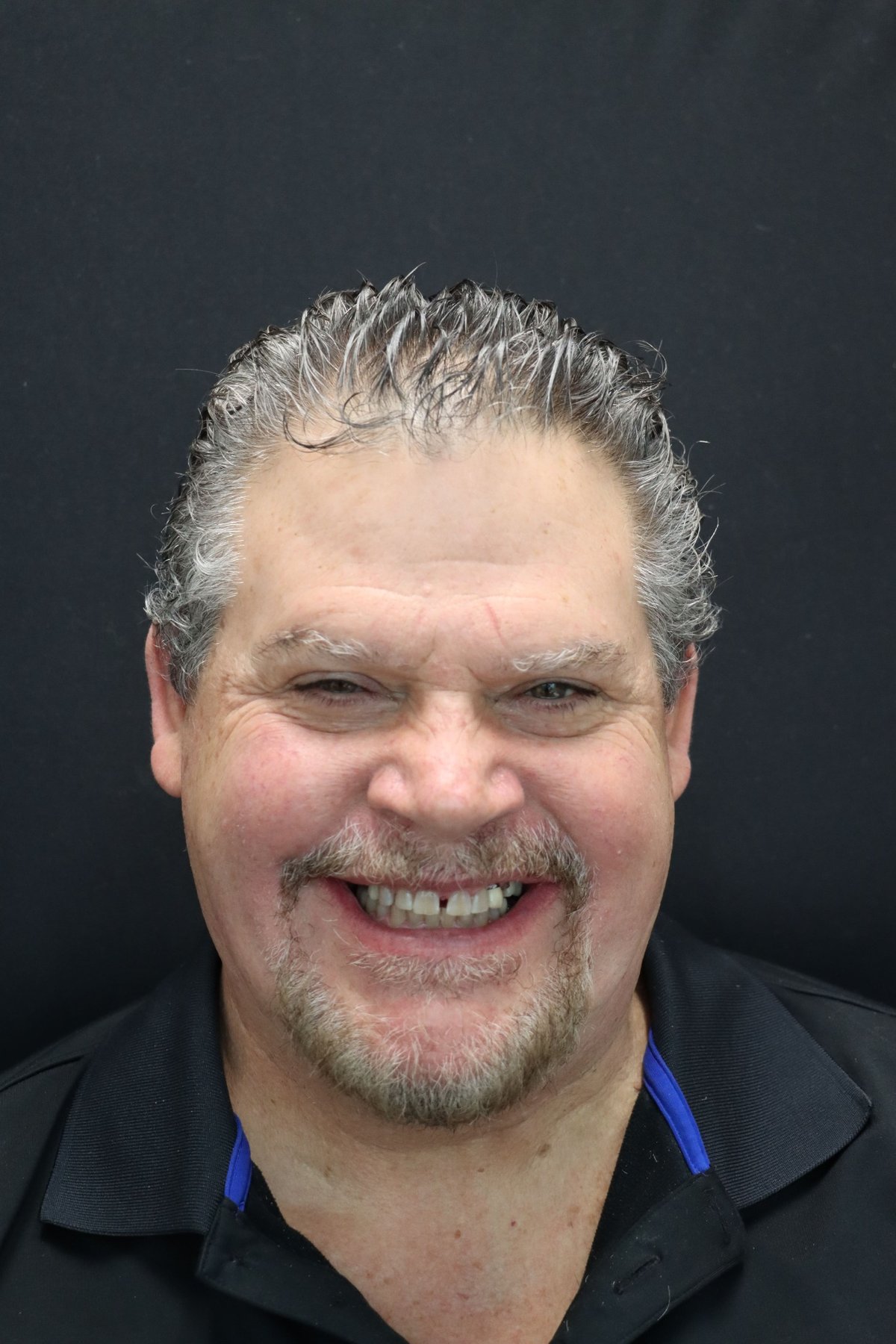 Dental implants Lynnwood WA patient smile transformation