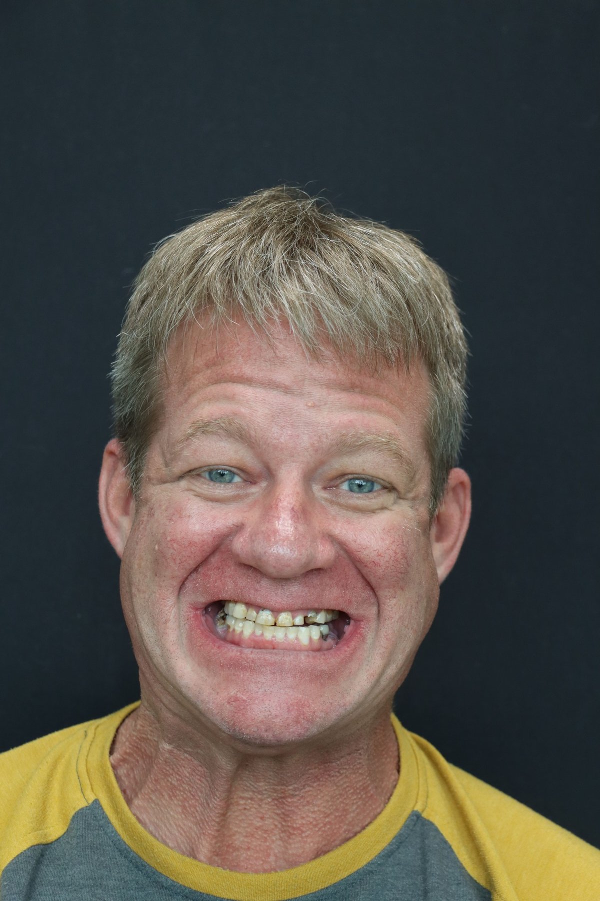 All-on-4 dental implants before and after smile transformation in Lynnwood