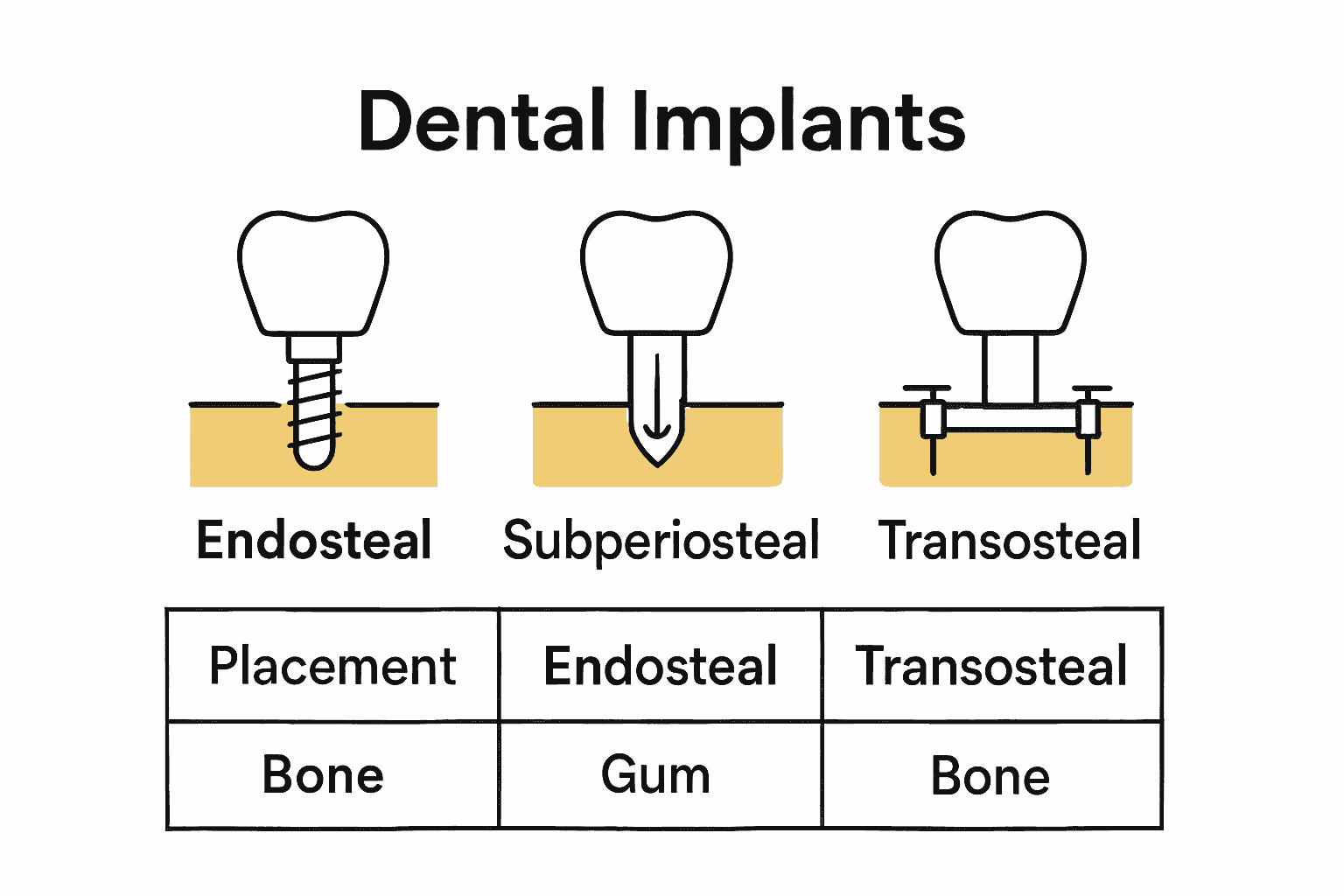 Infographic comparing three types of dental implants with icons for each.