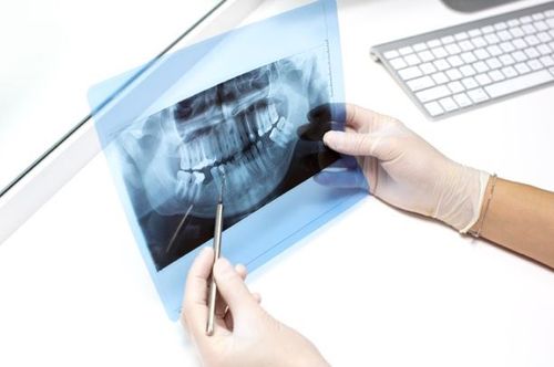 Painless Root Canals Treatment California Sonoma County