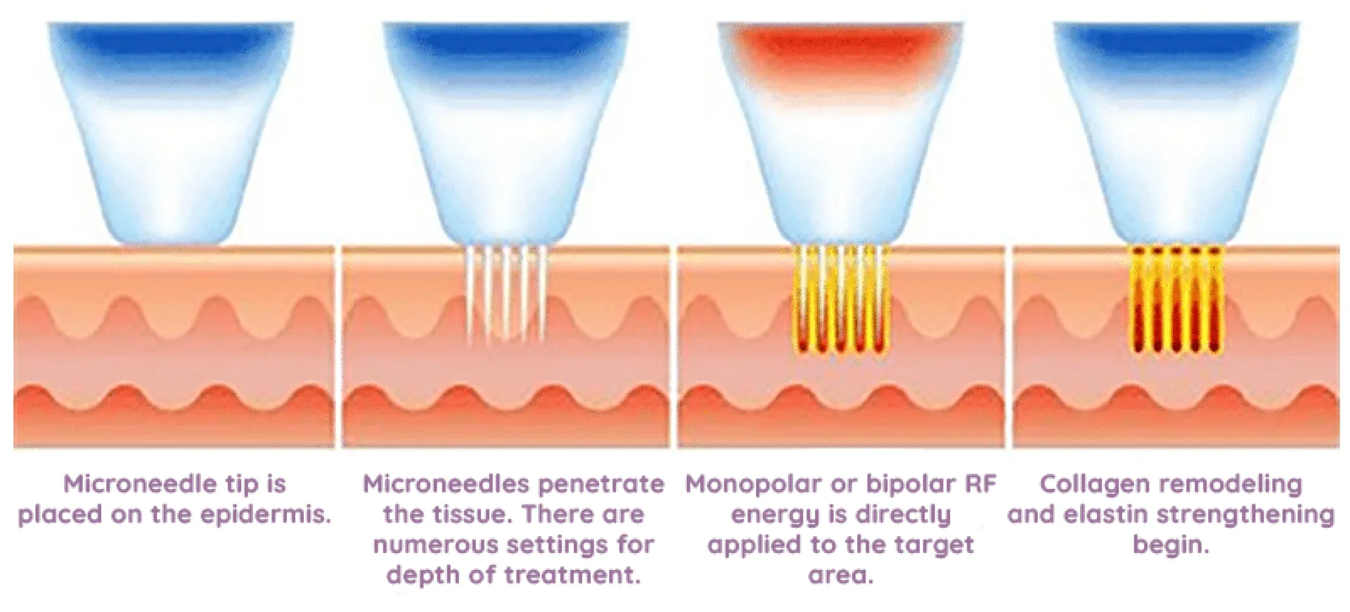 breast fold incision