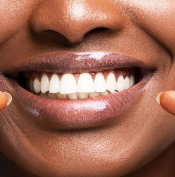 Final Retainers and Smile Reveal!