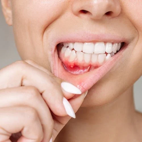 woman showing mouth ulcear