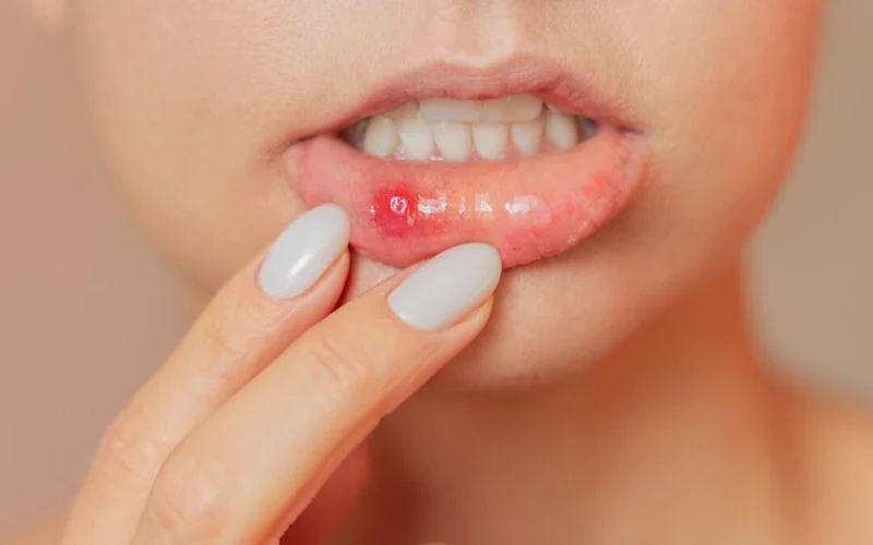 woman showing mouth ulcear