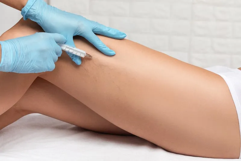 spider veins treatment with injection