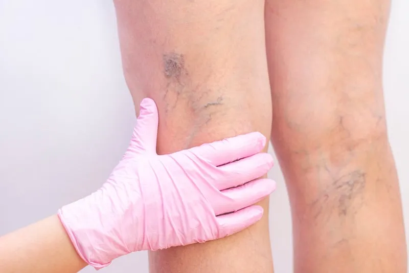 Spider veins