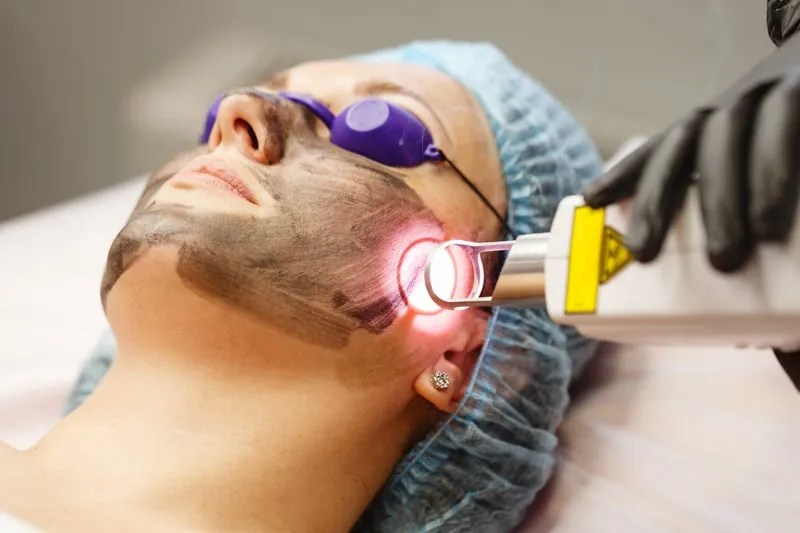 laser resurfacing treatment