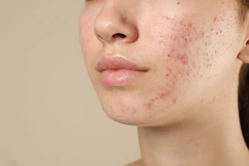 girl face with full of pimples