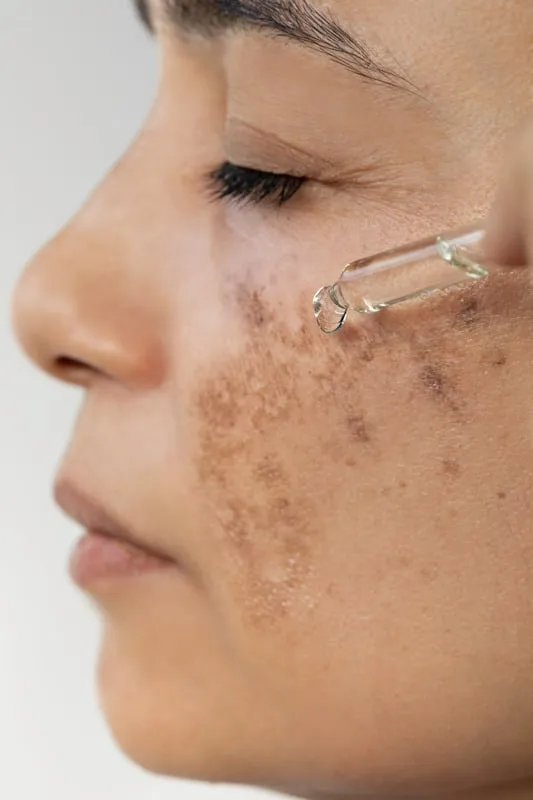 melasma scars