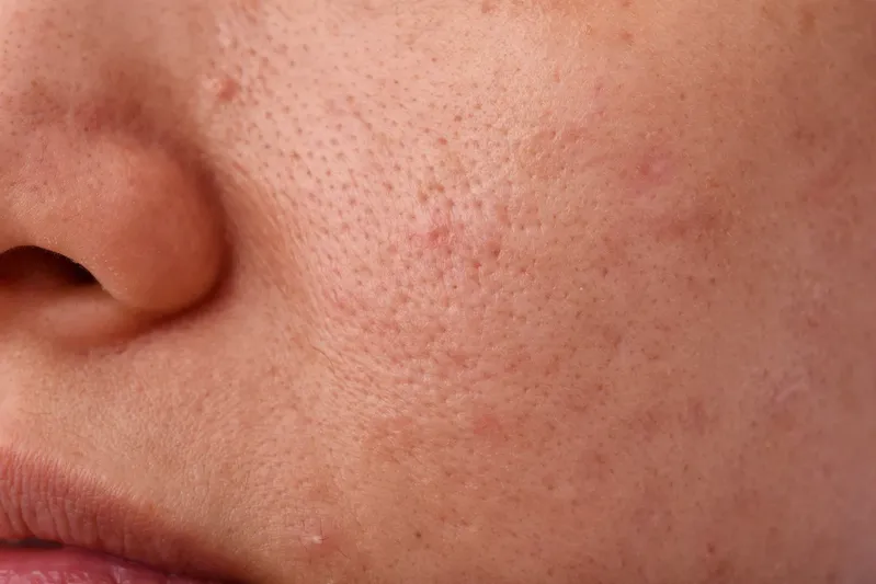 pores on cheek