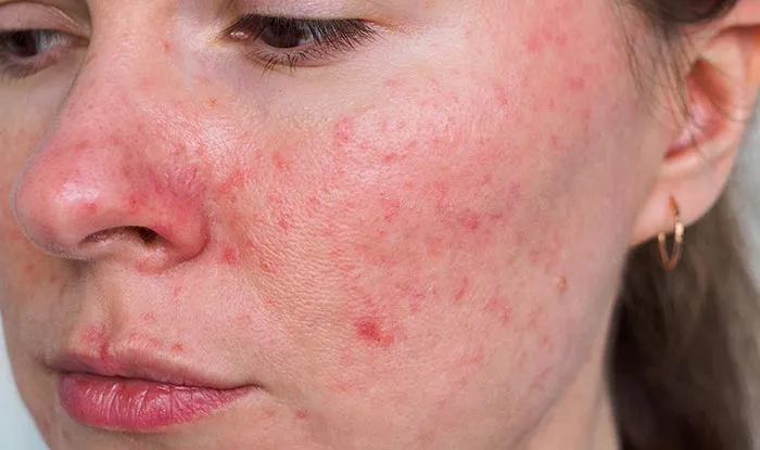 rosacea treatment