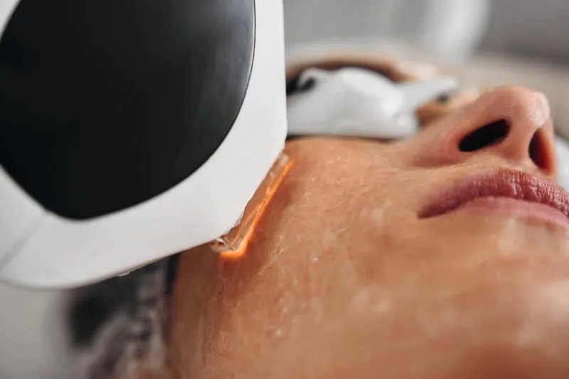 ipl skin rejuvenation