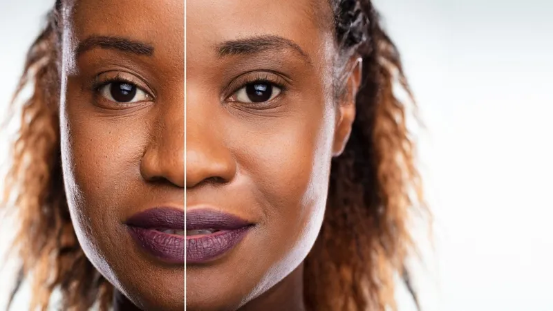 before and after Microdermabrasion