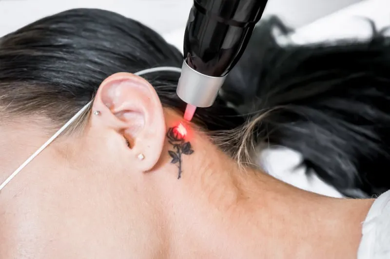 removing neck tattoo