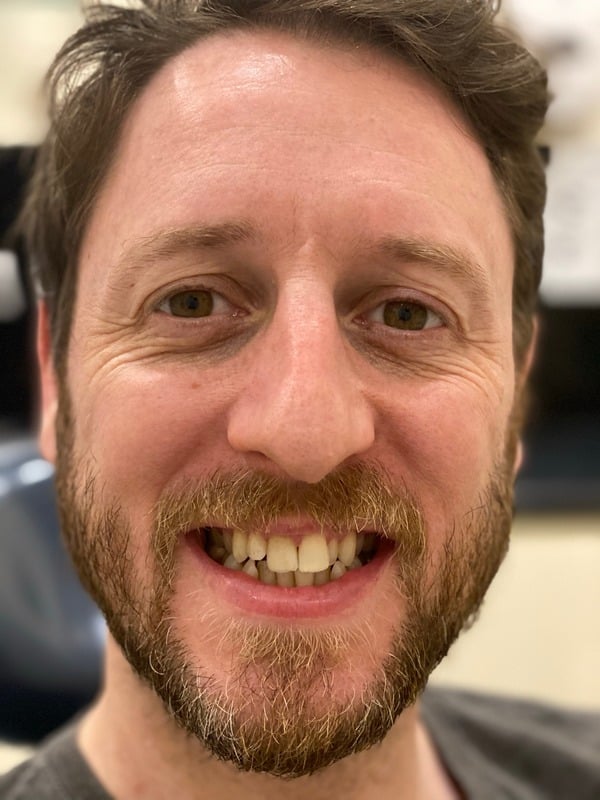 Before Invisalign