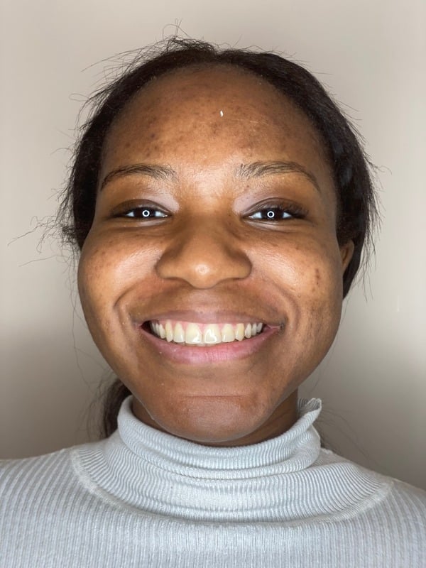 After Invisalign treatment