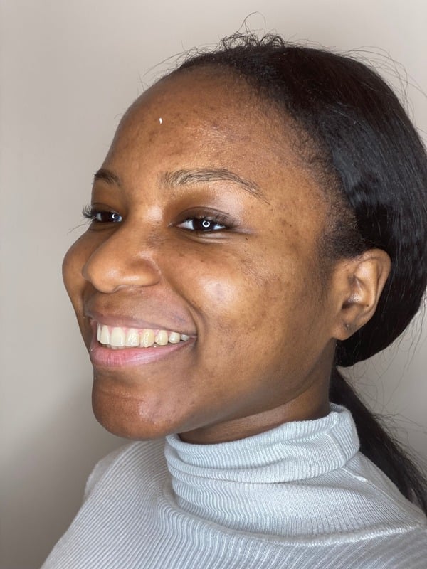 After Invisalign