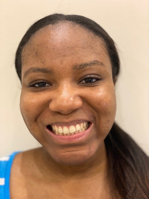 Before Invisalign