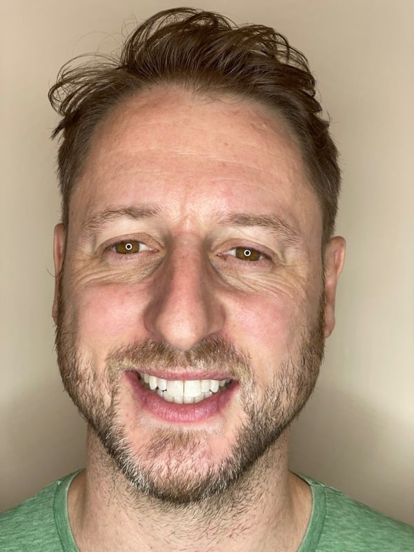 After Invisalign