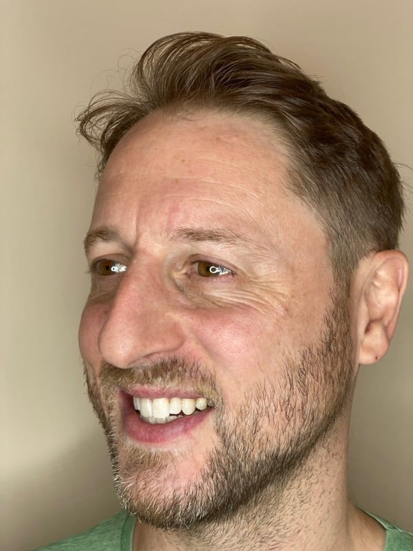 After Invisalign treatment