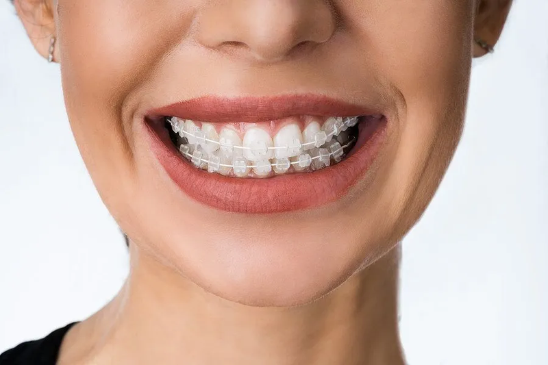 girl smiling with braces