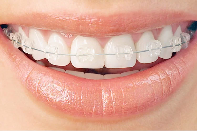 Smile with Braces