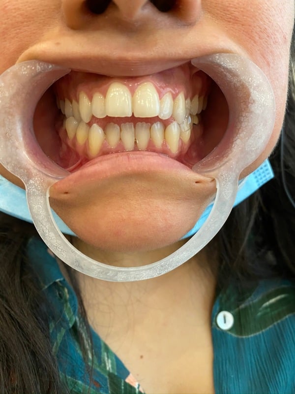 Before Invisalign